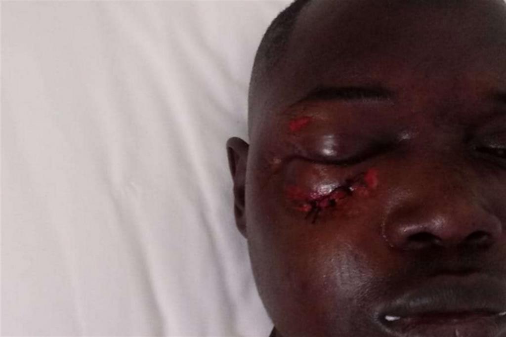 Il volto tumefatto di Kemo Fatty, 22 anni, dopo l'aggressione con una pietra