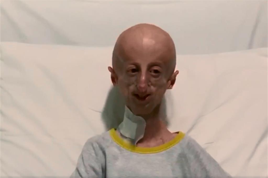 Sammy Basso, malato di progerie, parla dopo l'intervento al cuore