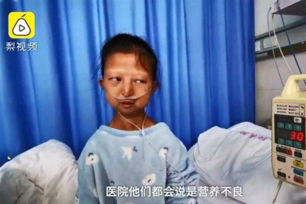 L'agonia di Wu Huayan morta di denutrizione per curare il fratello disabile