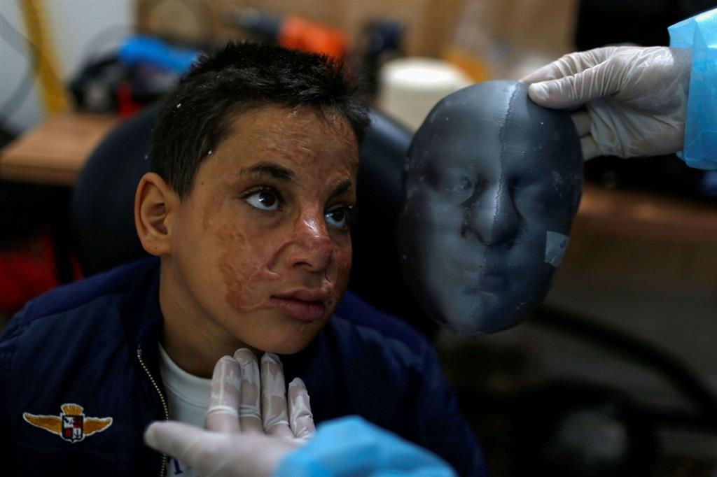 Ahmed Al-Deeb, adolescente di Gaza con gravi ustioni al viso, ha provato questa settimana la sua maschera terapeutica