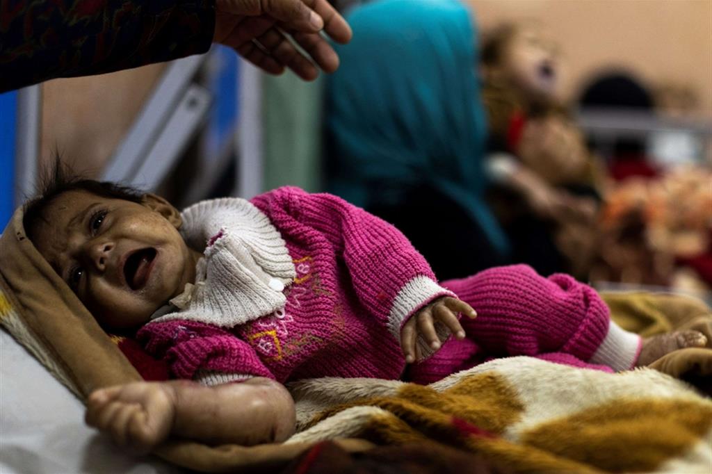 Una bimba in lacrime nel reparto di malnutrizione infantile all'ospedale Indra Gandhi di Kabul - Reuters