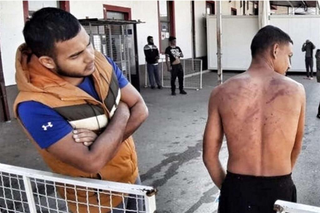 Uno degli stranieri torturati durante i respingimenti sulla “rotta balcanica”