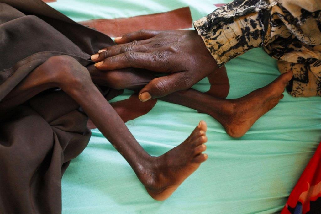 Una madre accarezza il figlio di due anni gravemente malnutrito in un ospedale a Dadaab, nel nord-est del Kenya - Ansa